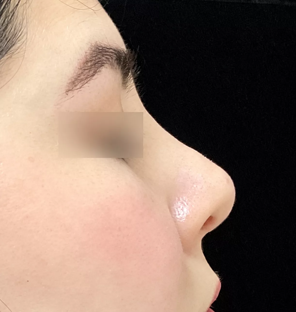 Fotografía de perfil nasal antes de la rinoplastia, de un caso autorizado por el paciente. Ojos cubiertos para proteger su identidad.